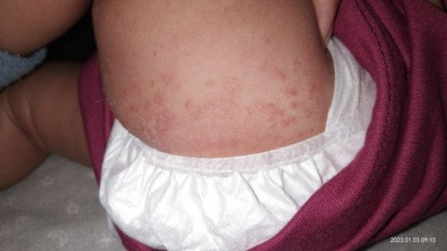 RUAM DIAREA BOKONG BAYI