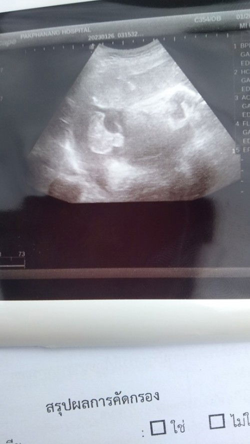 รังไข่น้องใช่ไหมค่ะ