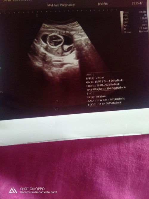 Hasil USG stelah pendarahan