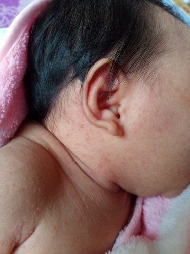 ลูก14วันมีตุ่มแบบนี้คืออะไรคะ