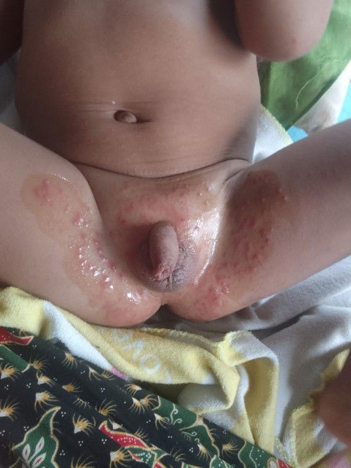 ขึ้นผืนแดงๆตามตัว