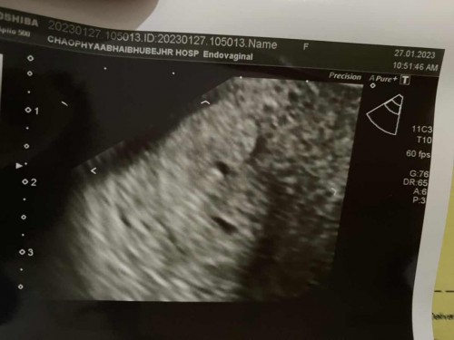 ท้อง5w5d ดูให้หน่อยนะคะ