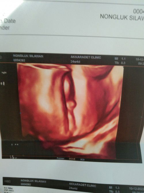 ขอดูภาพอัลตร้าซาวด์เพศลูกชายของเเม่ๆหน่อยค่ะ