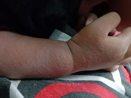 Apakah alergi Susu formula