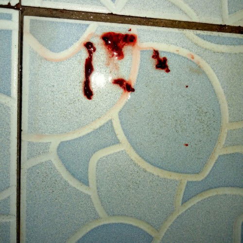 Keguguran di usia 8week