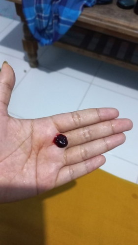 Bun ada yang hamil 7 bulan sering keluar gumpalan darah, sudah sering periksa diusg baik