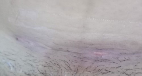 Luka saecar bernanah