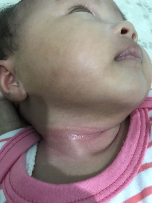 Ruam leher balik lagi