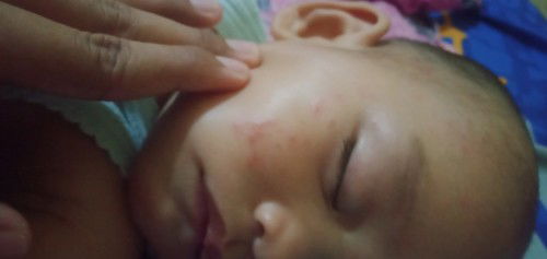 Bayi umur 9 bln bintik-bintik merah? katanya cacar? bener gak sih!??