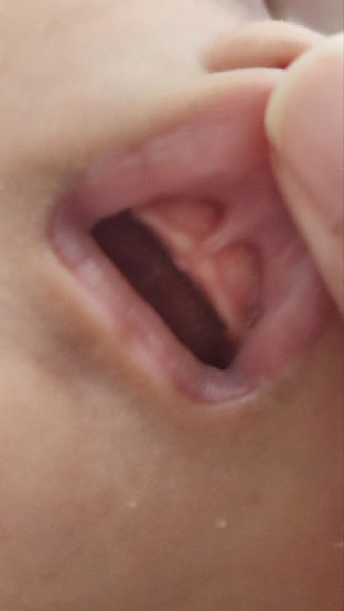 Lip tie / lip blisters