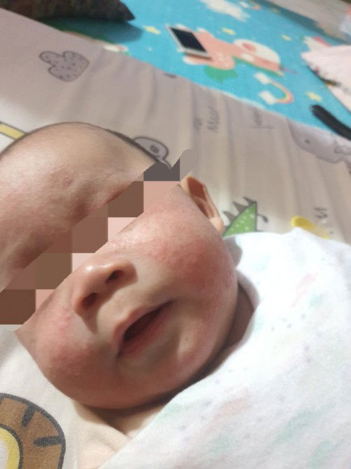 Ruam muka makin merebak. Ditambah dgn suka gosok muka,dah berjangkit ke mata.