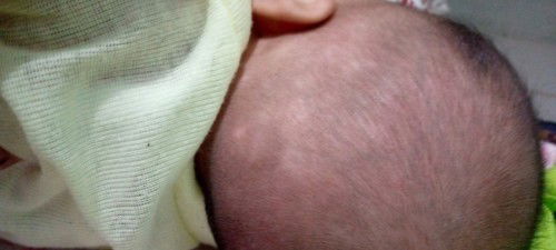 Bercak putih seperti panu