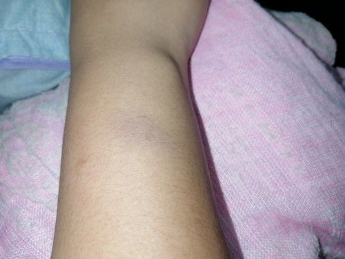 Tiba2 naik lebam kat tangan