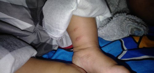 Bintik merah di kaki