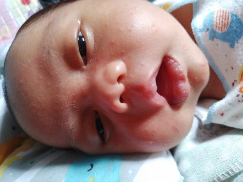 Bintik² merah area wajah bayi
