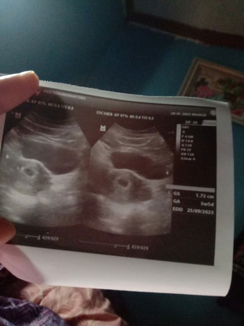 Hasil usg beda sma hpht