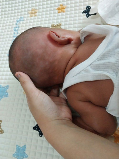 Belang2 putih pada kulit bayi