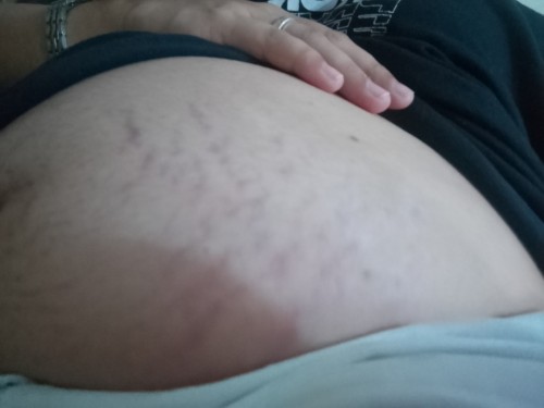 Ano pong gamit nyo para sa stretch marks nyo?