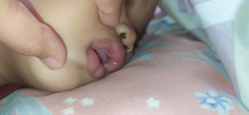 Mulut bayi kena jamur