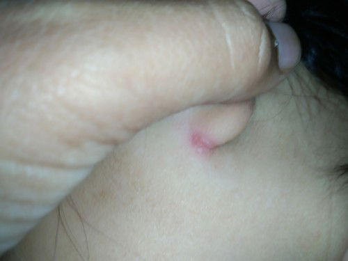 น้องเป็นผื่นลามมาที่หู