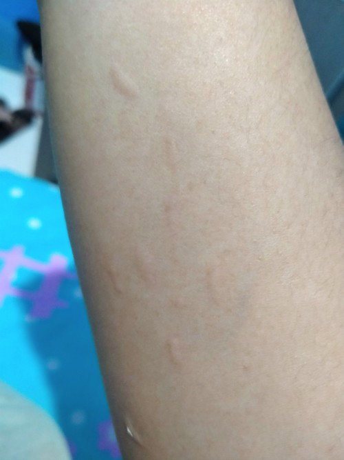 Gatal setelah di pijat