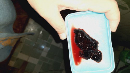 Keluar gumpalan setelah kuret