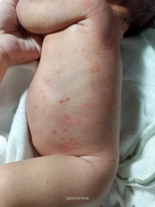 baby acne??