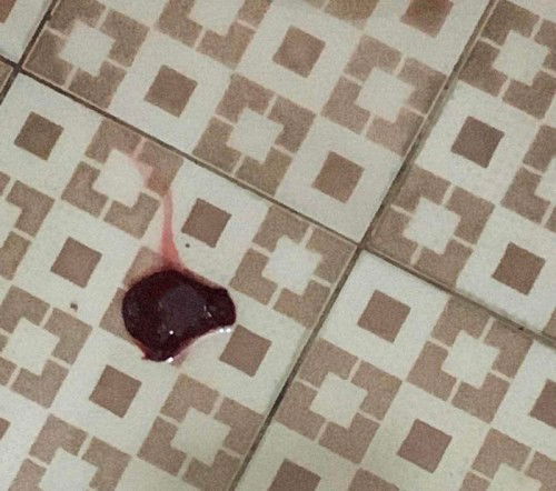 Pendarahan sampai keluar gumpalan darah besar