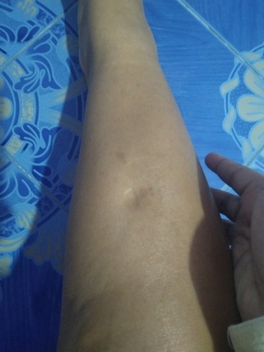 เข้า34w ขาบวมกดบุ๋ม