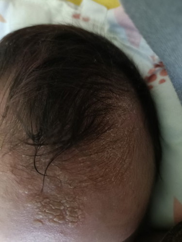 Hi mga Mommy ask ko lang po ano po.kaya gamot sa rashes po ng baby ko sa kanyang ulo.