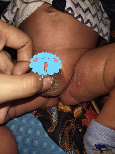 Ruam celah paha baby