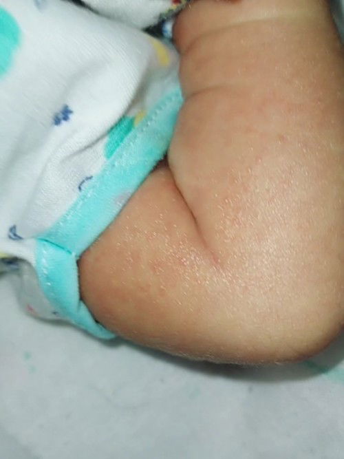 ผื่นแบบนี้ควรรักษายังไงอันตรายไหม