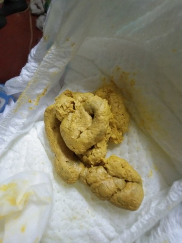 maam pasingit po yung baby ko po kapag mag poop matigas yung unang labas n