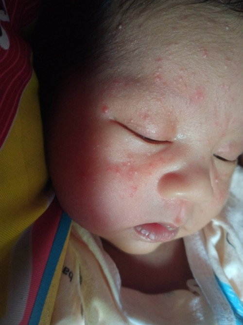 ที่ขึ้นเเบบนี้คือน้องเป็นอะไรคะ
ต้องใช้อะไรถึงหายคะ