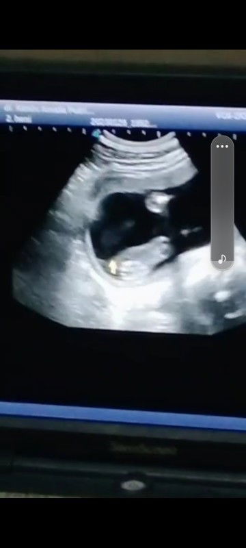 Kehamilan Hpl juni2023