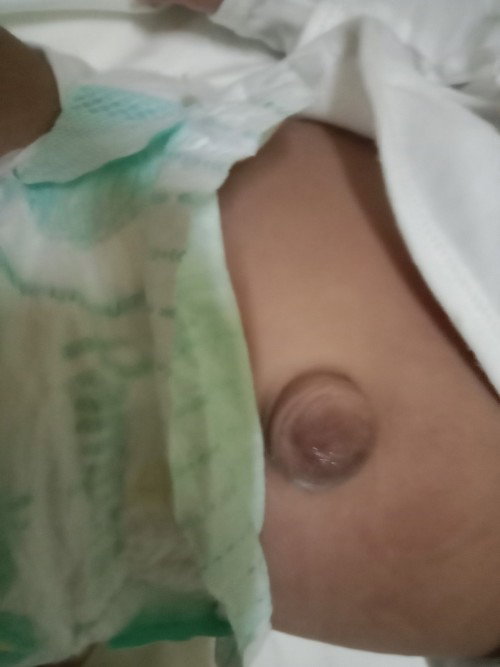 Sino Po sa Inyo Ang may same case Po sa lo ko?may umbilical Hernia Po Siya,Kusa Po ba itong Nawawala