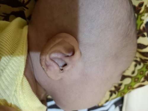 Serius tanya, telinga keluar cairan