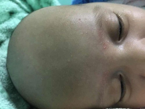 ผดเม็ดเล็กๆขึ้นที่หน้าล่ะหัวลูก 1เดือน