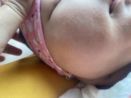 Bruntusan pipi bayi