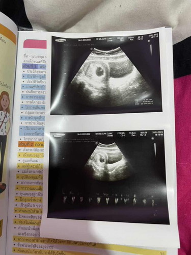 ฟังเสียงหัวใจน้องครั้งแรก 6+6w