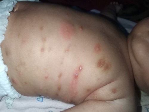 Bentol menonjol merah