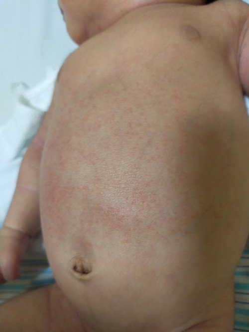 Aceite De Manzanilla/ Rashes