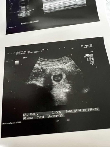 ภาวะแท้งคุกคาม 7สัปดาห์