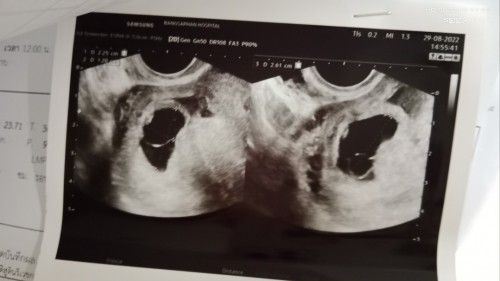 แชร์ประสบการณ์ท้องลม