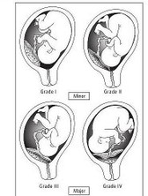 Placenta previa grade 1