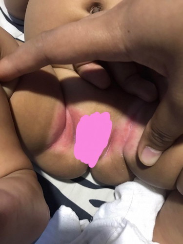 สอบถามแม่ๆค่ะ มียาอะไรใช้แล้วหายบ้างค่ะละนี่เกิดจากแพ้แพมเพิสรึป่าว