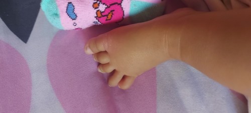 Mga momsh anu po itong tumubo kay baby at anung pwedeng igamot