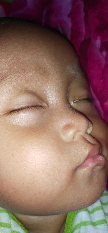 bercak putih di kelopak mata dekat bulu mata