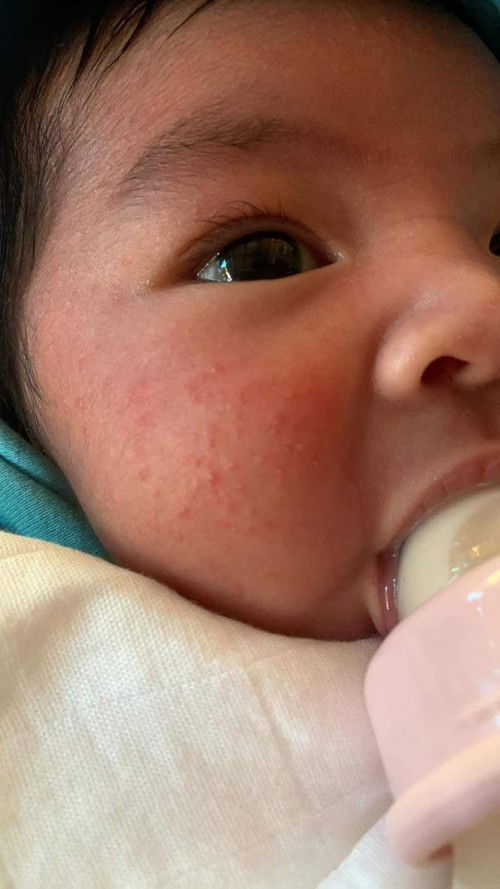 สอบถามแม่ๆค่ะแบบนี้ผดร้อนหรือผดอะไรคะ