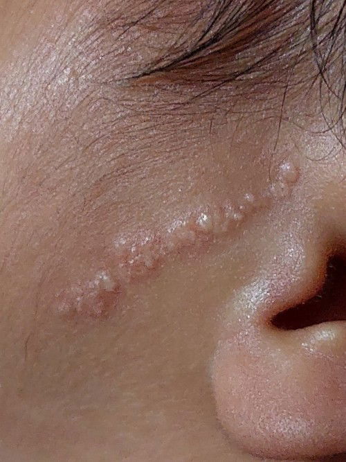 Tanda lahir mirip jerawat